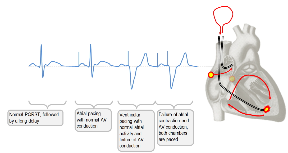 Single and dual chamber pacing modes Deranged Physiology